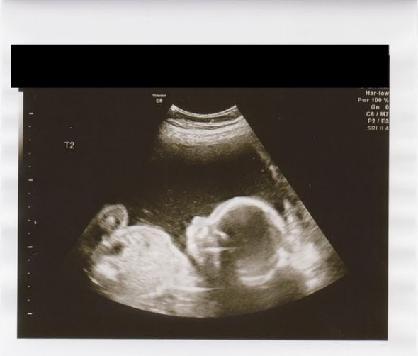 Ladies due in the Summer/Fall 2011 - Gender Updates and Baby/Bump Pictures!!! :  wedding babies second trimester gender bump pictures belly Twin 2 At 22 Weeks Plus One Day ED