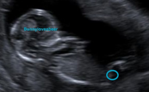 The nub theory - predicting gender early :  wedding Nub1