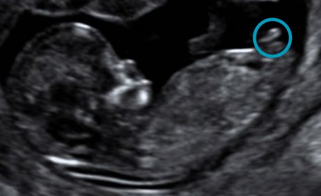 The nub theory - predicting gender early :  wedding Nub3