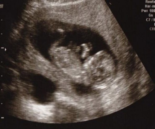 Has anyone here seen a perinatologist? :  wedding 12weekultrasound