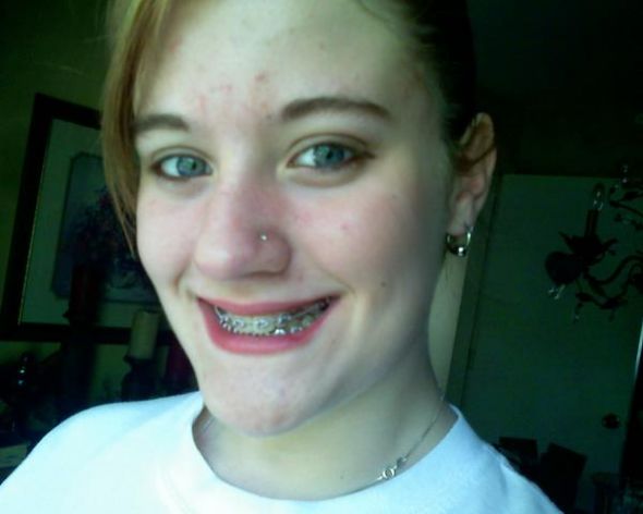 Before and After - Brides with Braces! :  wedding L 7fdb7c31b0b617c5211a9f53250ebf59