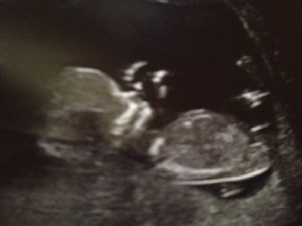 The nub theory - predicting gender early :  wedding Nub Photo