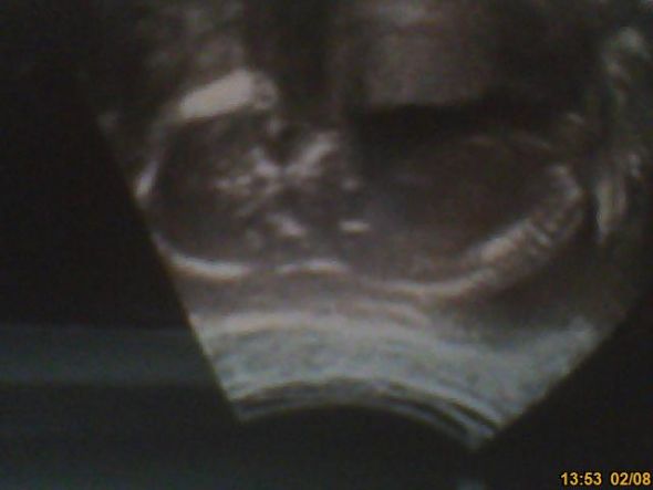 The nub theory - predicting gender early :  wedding 17 Weeks