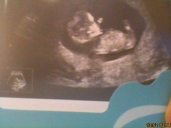 The nub theory - predicting gender early :  wedding Scan 11 Week