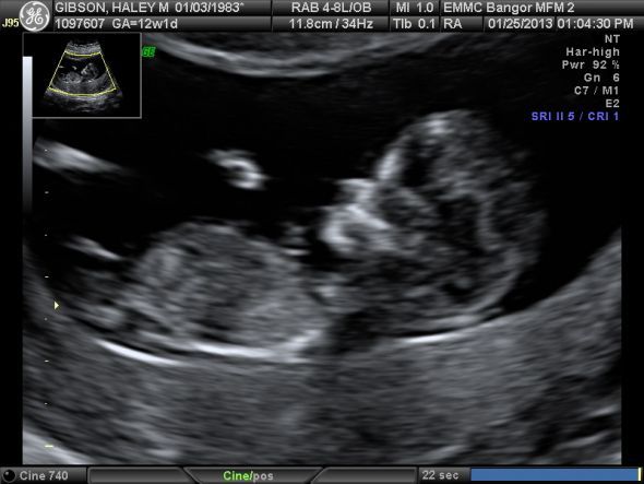12 week ultrasound pictures girl