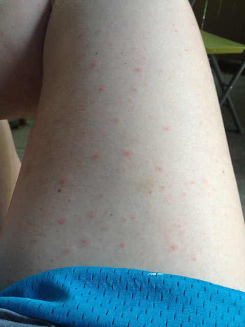 what-are-these-red-dots-on-my-inner-thigh-picture