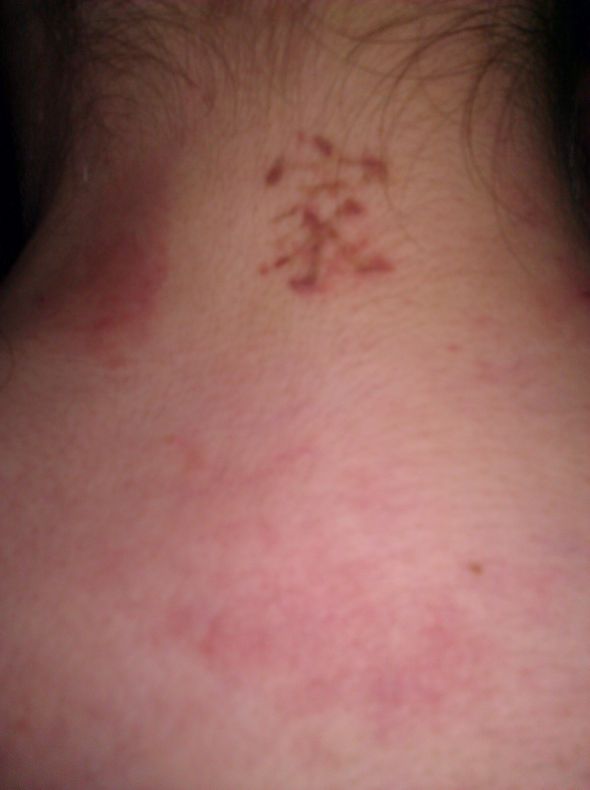 Tattoo Removal : wedding 2ndtreatmentneck