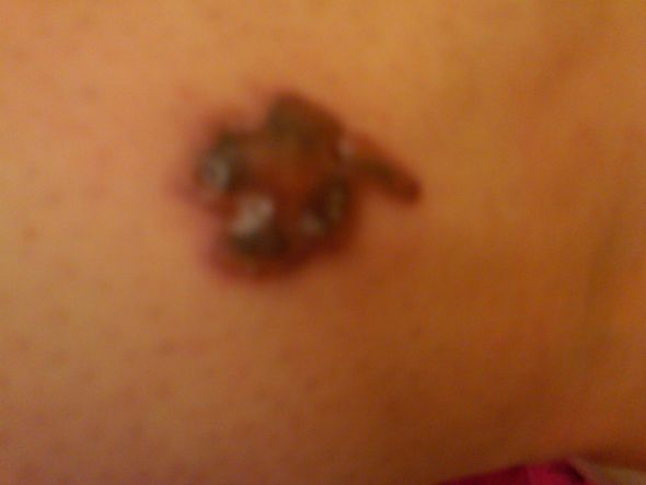 Tattoo Removal : wedding 2treatmentclover