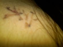 Tattoo Removal : wedding Backtattoo3