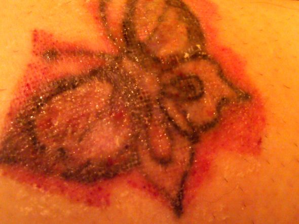 Tattoo Removal : wedding Butterfly2treatment