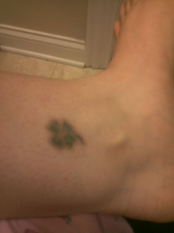Tattoo Removal :  wedding Clover123