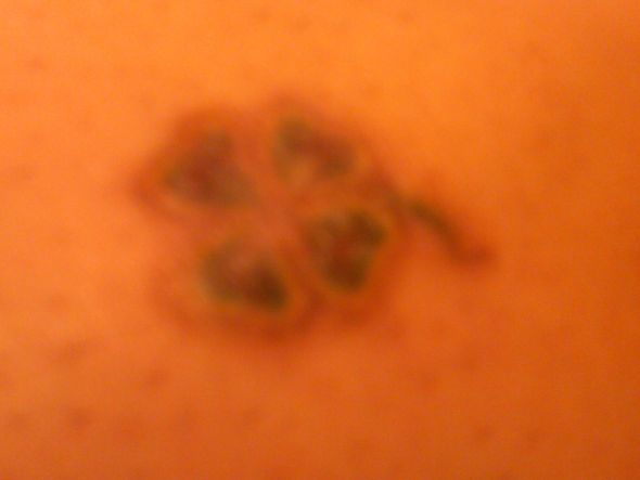 Tattoo Removal : wedding Clover3weeks2treatment