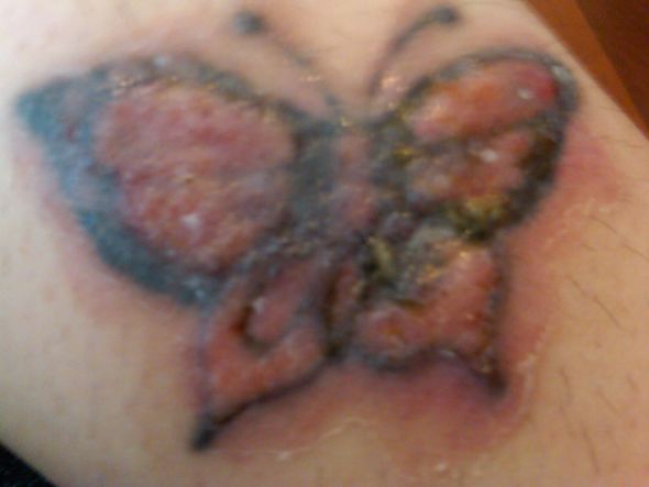 Tattoo Removal : wedding Leg2.2weeksafter2ndtreatment