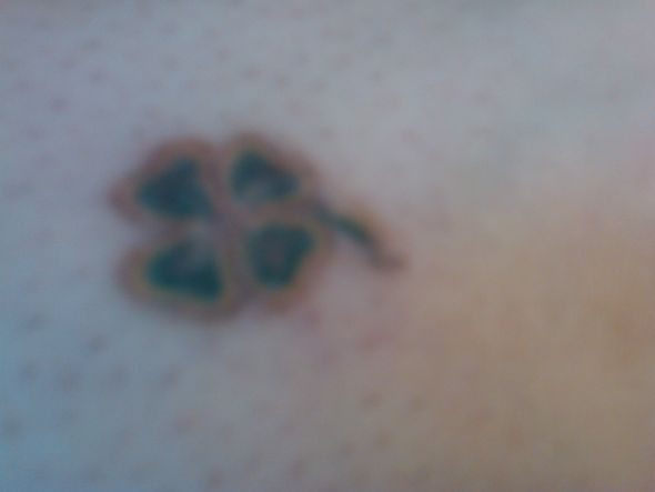 Tattoo Removal : wedding Leg5weeksafter2ndtreatment