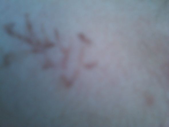 Tattoo Removal : wedding Neck5weeksafter2ndtreatment