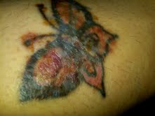 Tattoo Removal : wedding Tattoo2week2