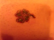 Tattoo Removal : wedding Tattooweek1