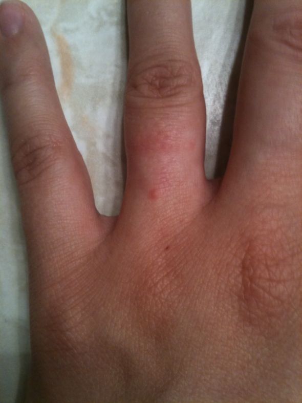 Bump under engagement ring? :  wedding Finger
