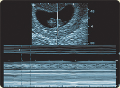Pregnant/Momma Bees: When did you first hear heartbeat? :  wedding baby heartbeat M Mode