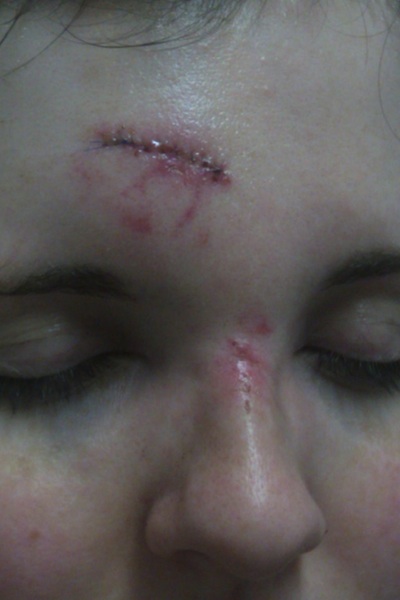 For those with scars they may want to minimize (Warning- semi-gross picture) :  wedding Scar