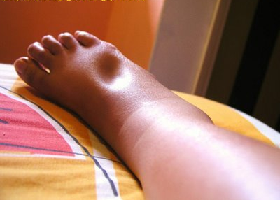 Swollen Feet :( : wedding Legs Swelling1